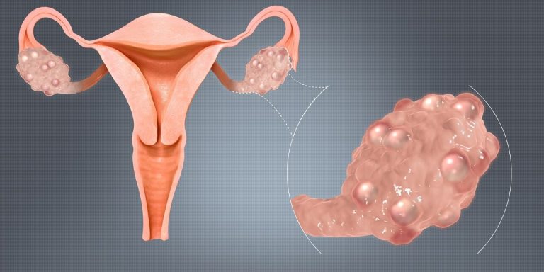 OVARIAN CYSTS