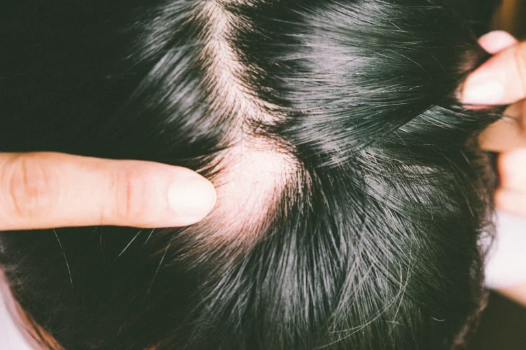 ALOPECIA AND IT’s HOMEOPATHIC TREATMENT