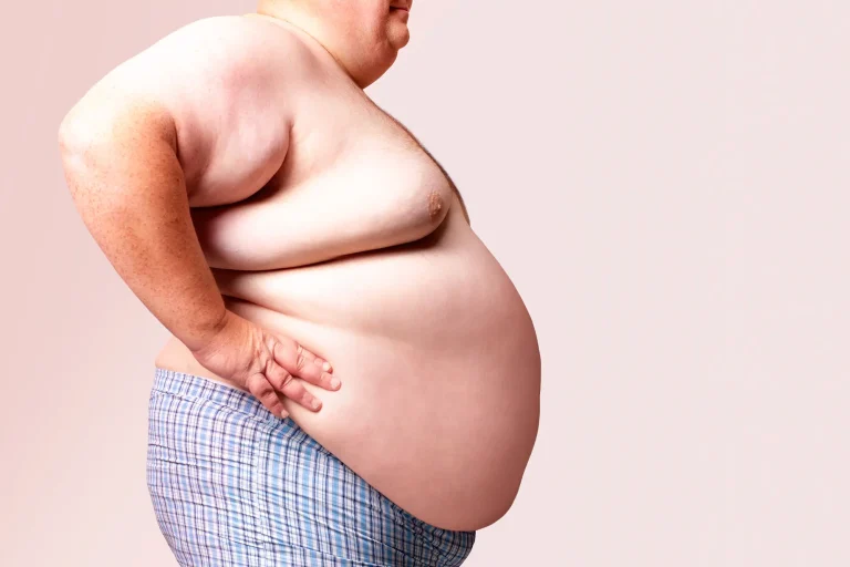 Obesity: How can we defeat it with help of Homeopathy